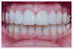 Los Angeles Porcelain Veneers