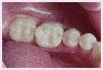 Los Angeles White Fillings