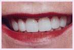 Los Angeles Dental Veneers