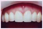 Los Angeles Teeth Bleaching