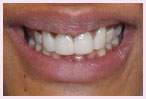 Los Angeles Root Canal