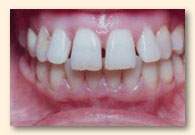 Los Angeles Cosmetic Veneers