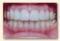Los Angeles Cosmetic Veneers