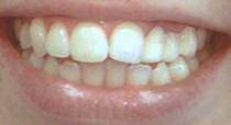 Los Angeles Dental Veneers