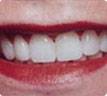 Los Angeles Porcelain Veneers