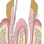 Los-Angeles-Root-Canal