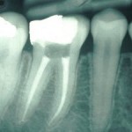 Root-Canal-Los-Angeles