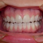 Los-Angeles-Teeth-Whitening-150x150