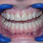 Teeth-Whitening-150x150