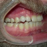 Dental-Implant-Dentist-150x150 (1)