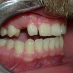 Dental-Implant-Dentistry-150x150