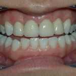 Dental-Veneers-150x150 (1)