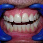 Dental-Veneers-Los-Angeles-150x150
