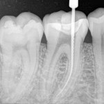 Los-Angeles-Root-Canal-150x150