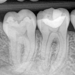 Root-Canal-Dentist-Los-Angeles-150x150