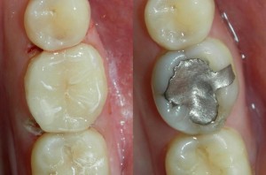 Replacing-Silver-Fillings-300x198