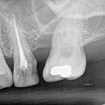 Root-Canal-Dentist