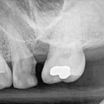 Root-Canal-Pain
