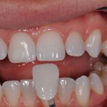 Dental-Veneers-150x150