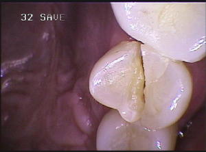 Cracked Tooth Syndrome - It\u0026#39;s More Common Than You Think!