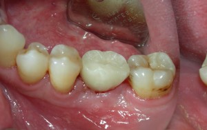 Los-Angeles-Implant-Dentist-300x189