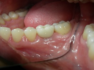 Dental-Implants-300x225