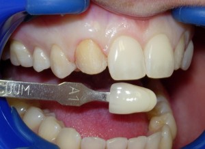 Broken & Chipped Tooth Repair Larchmont