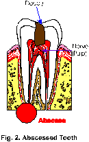 abceessed tooth