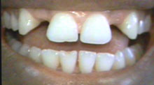Before Missing Lateral Incisors
