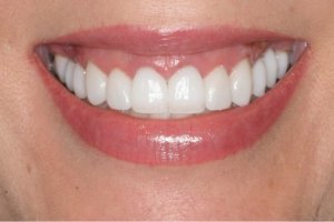 Porcelain Crowns with Cosmetic Dentistry