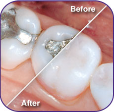 Mercury Fillings