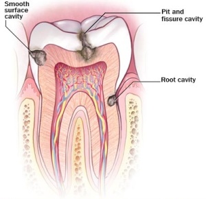 Dental-Decay-Process-1-300x290.jpg