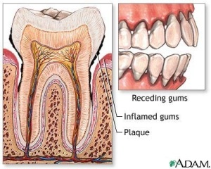 Gingivitis gum disease (2)