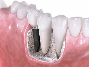 Dental Implants