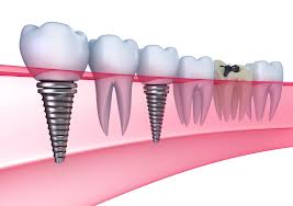 Implant Dentist Los Angeles