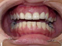 Anterior Esthetic After