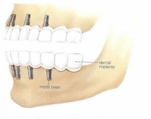 dental-implants-1