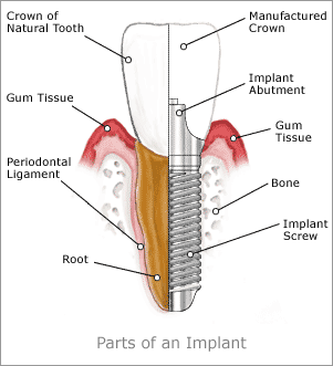 dental-implants-2