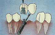 Lower Implant & Bridge