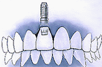 Single Tooth Implant With Crown