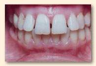 los-angeles-cosmetic-veneers-1