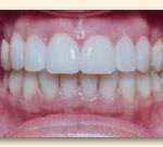 los-angeles-cosmetic-veneers-2