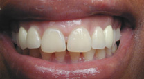 Implants and Porcelain Crowns