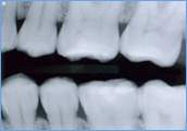 expose dental x-ray