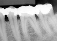 expose dental x-ray