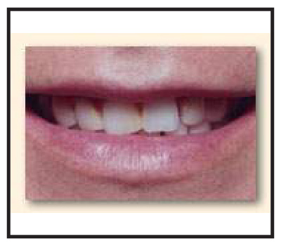 veneers