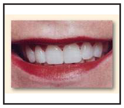 veneers