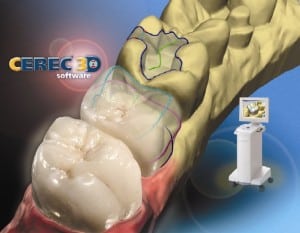 Cerec Crown