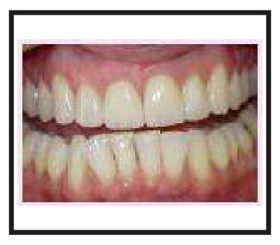 Dental Veneers