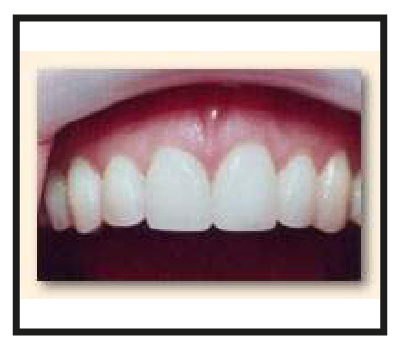 Dental Bleaching